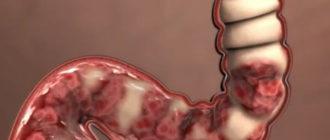 Молочница из-за проблем в кишечнике