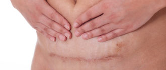 Воспаление после кесарево