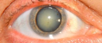 Мешает в глазу после света