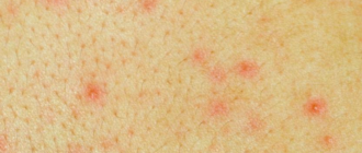 Вич достоверность теста при наличии сыпи по телу