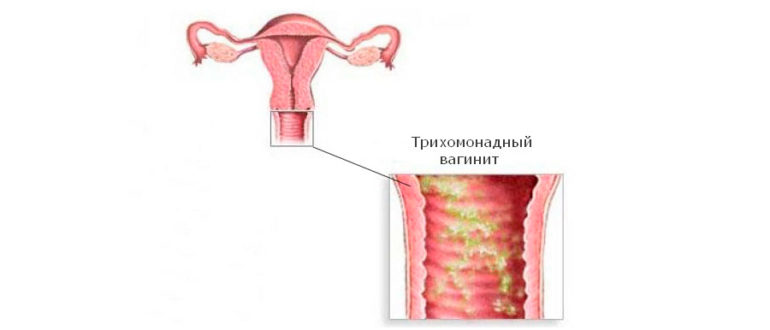 Вагиниты трудно поддающиеся лечению