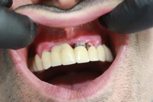 Можно оставить корень разрушенного зуба в десне на пару месяцев?