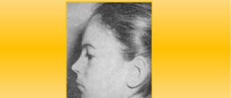 Дермоидная киста подбородочной области