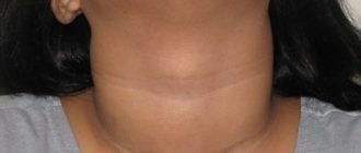 Узловой зоб 2 степени после родов