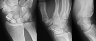 Краевой перелом ладьевидной кости