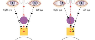 Двоится в левом глазу