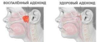 Частые ОРВИ, осложнения. Аллергия или аденоиды