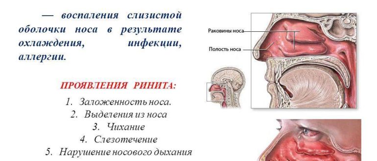 Уже год беспокоит горло и насморк