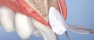 Выпала ватка из лунки зуба