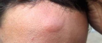 Водяная шишка после удара