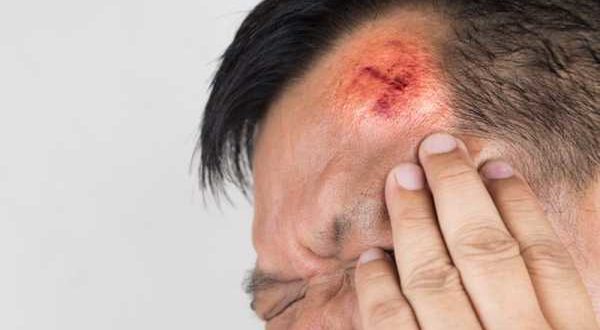 Мурашки в голове, свист, головокружение