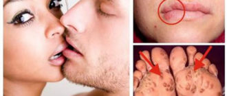 Можно ли целоваться при хламидиозе