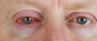 Может ли опухнуть глаза пои аллерги на рыбу