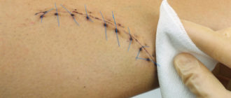 Можно ли зашить рваную рану через неделю после получения?