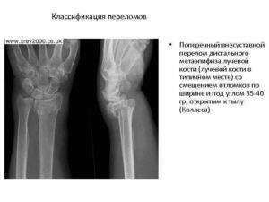 Экстензионный перелом дистального метаэпифиза лучевой кости со смещением