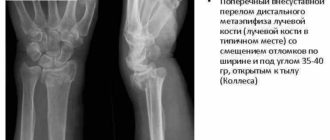 Экстензионный перелом дистального метаэпифиза лучевой кости со смещением