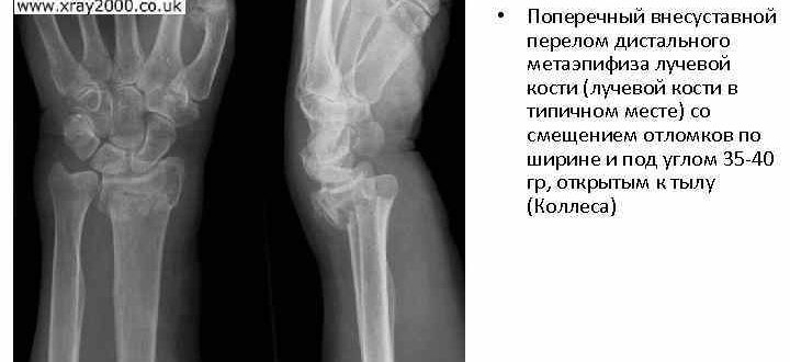 Экстензионный перелом дистального метаэпифиза лучевой кости со смещением