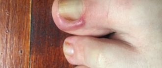 Надорвала ноготь на большом пальце ноги, палец опух и болит