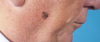 Кожа во круг родинки покраснела и шелушится