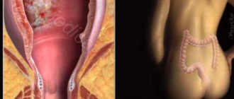 Выделения из влагалища при дефекации