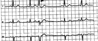 Наджелудочковая эктопия