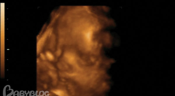 Узи в 30 недель с доплером