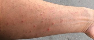 Много прыщей на внутренней стороне руки