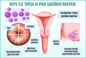 Впч и рак шейки матки