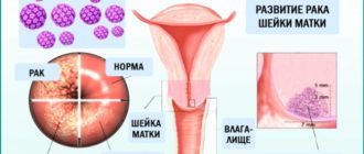 Впч и рак шейки матки