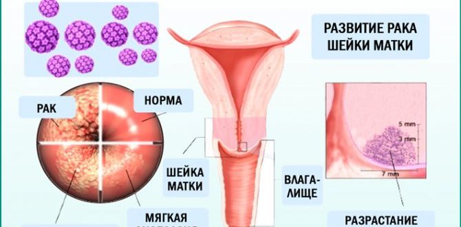 Впч и рак шейки матки