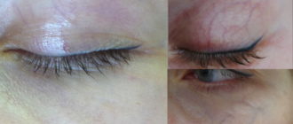 Вены под глазами