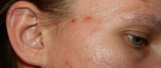 Чешуйчатые пятна на лице