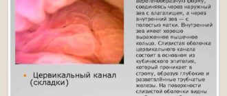 Выраженная складчатость эндоцервикса