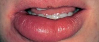 Возможен ли сильный отёк при герпесе?