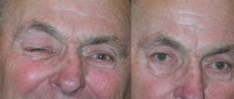 Дергается глаз и половина лица