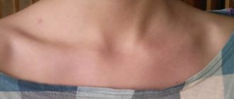 Надключичный лимфоузел