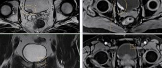 Может ли МРТ не показать опухоль мочевого пузыря