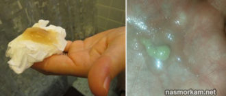 Что значит выходящая мокрота ввиде комочков из горла