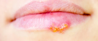 Что за болячка и чем лечить