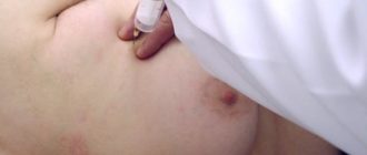 Втянутый сосок левой груди, уплотнее 2 мм