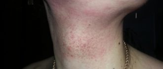 Что это может быть. Сыпь на шее болит