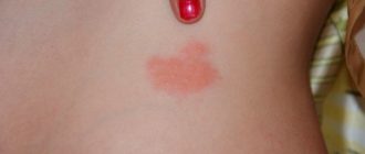 Что-то красное на коже