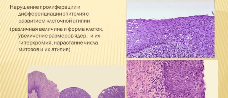 Дисплазия и пролиферация