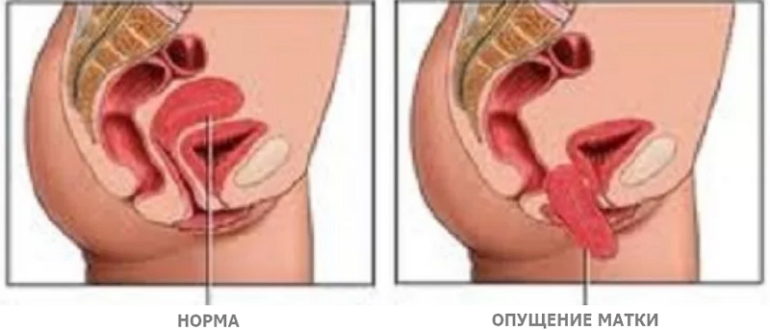 Дискомфорт во влагалище во время беременности