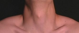 Выпирает кадык и шишка над кадыком