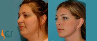 Второй подбородок при худобе