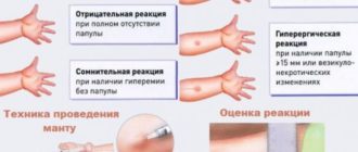 Можно ли делать пробу манту при реактивном панкреатите