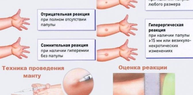 Можно ли делать пробу манту при реактивном панкреатите