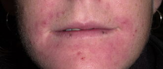 Может дерматит пройти сам?