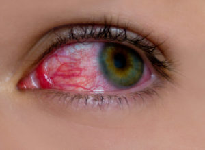 Чем лечить ожоги глаз?
